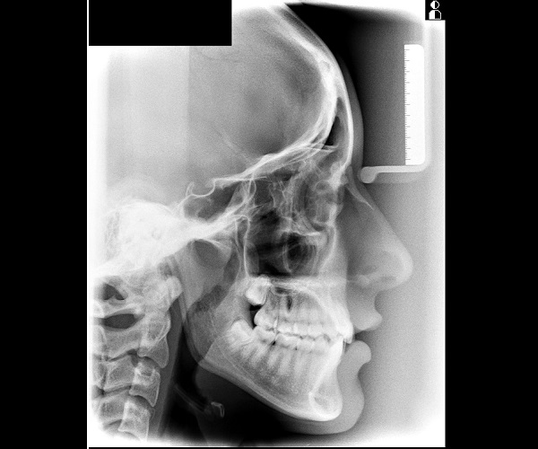 telerradiografía lateral de cráneo