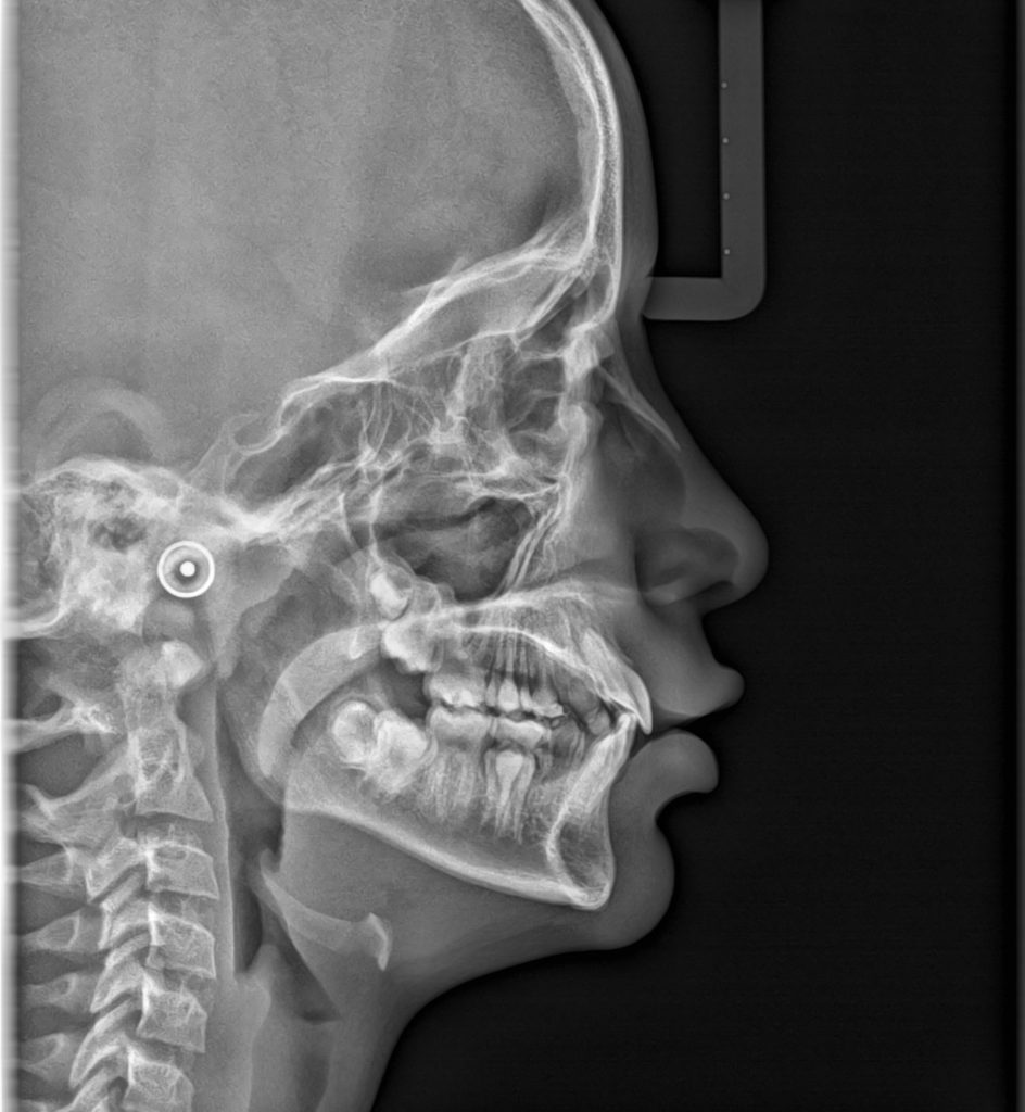 tele lateral de cráneo telerradiogragia